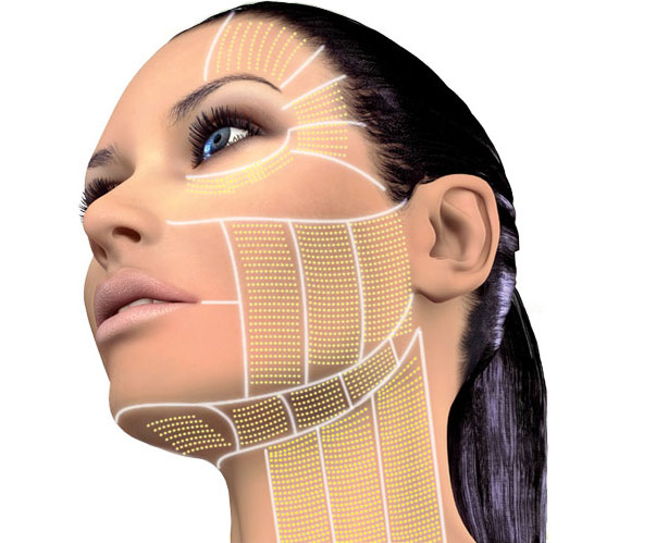 HIFU (high intensity focused) 