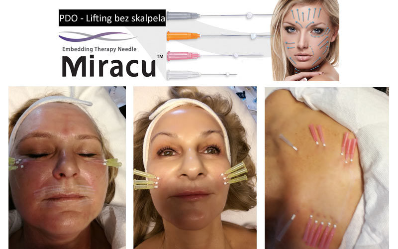 Nici Liftingujące PDO