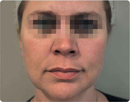 profilo rezultaty72 after