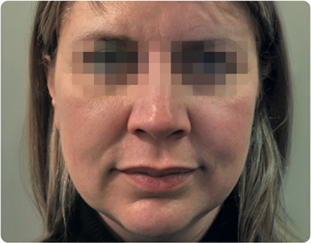 profilo rezultaty72 before