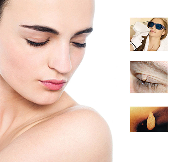 Usuwanie włókniaków